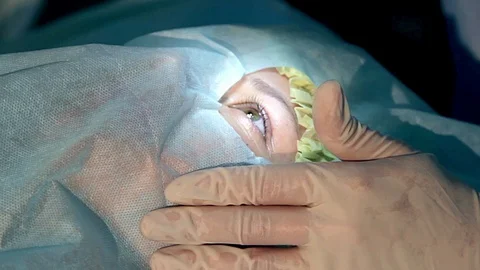 Operation of laser vision correction Video stock 98258435