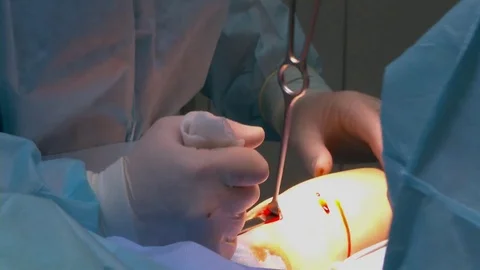 Operation on the leg implant inserted. Video stock 73948514