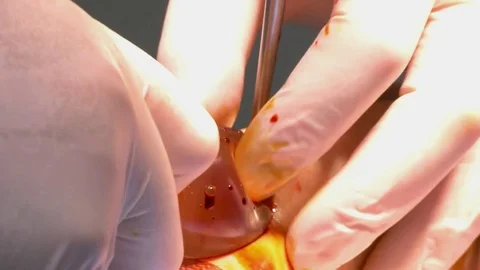 Operation on the leg implant inserted. Video stock 73948631