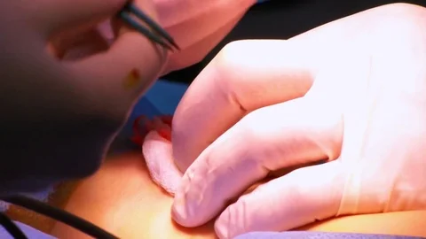 Operation on the leg implant inserted. Stock Footage 73949141