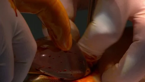 Operation on the leg implant inserted. Video stock 76639110