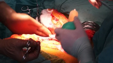 Operation of  liver transplant Video stock 88186507