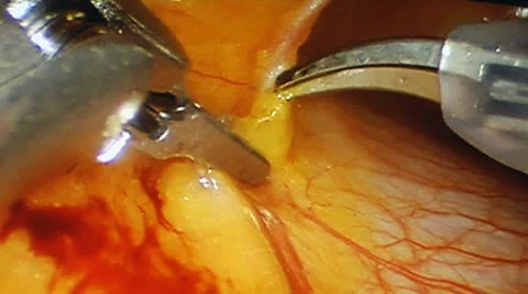 Operation Shunting macro Vídeo Stock 10915193