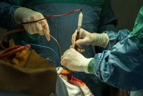 Operation of trepanation of the skull. Stock Photos