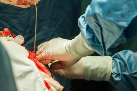 Operation of trepanation of the skull. Stock Photos