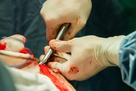 Operation of trepanation of the skull. Stock Photos