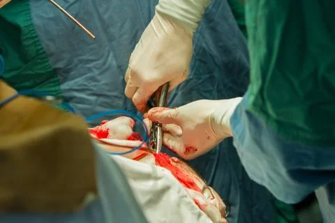 Operation of trepanation of the skull. Stock Photos