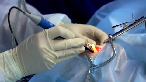Operation under General Anesthesia. Patient in Medical Protection. Cold Plasma Stock Footage 147349783