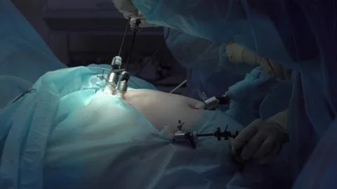 Operation using laparoscopic equipment. Surgeons team. Hospital. Stock Photos