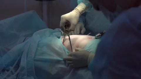 Operation using laparoscopic equipment. Surgeons team. Hospital. Stock Photos