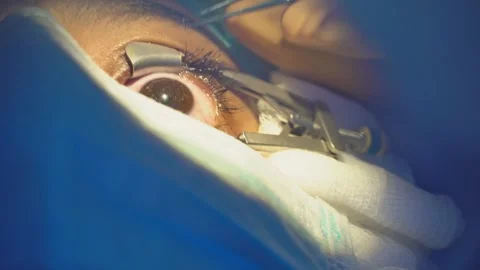 Ophthalmic procedure close-up showing laser surgery, lens implant, corneal Stock Footage 294687036