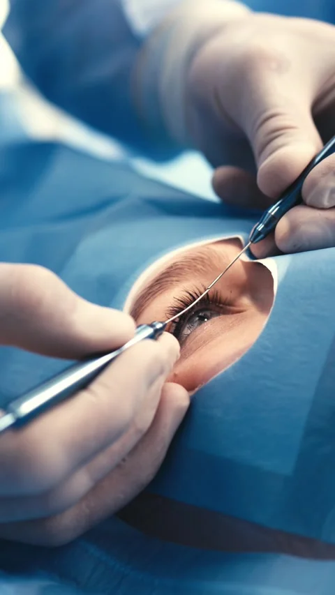 Ophthalmic surgeon performing delicate eye surgery with precision instruments, Stock Footage 337386208