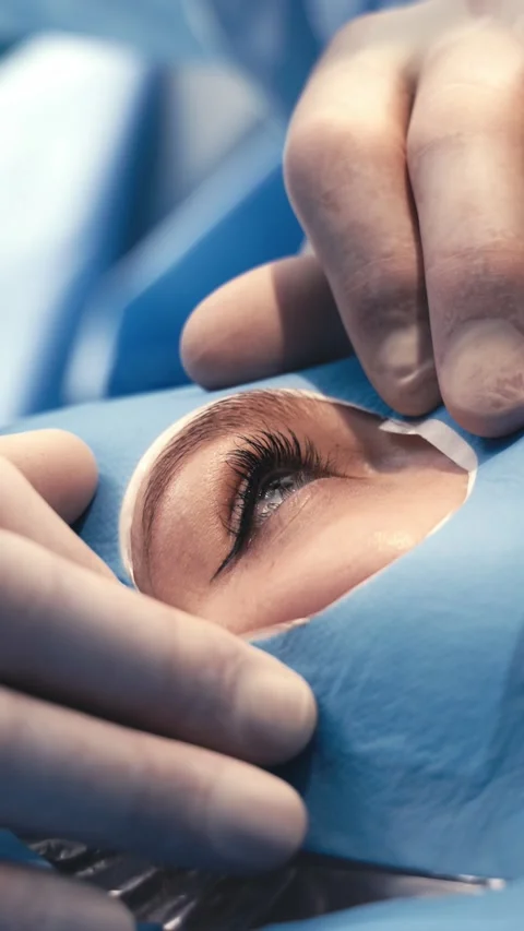 Ophthalmic surgeon performing delicate eye surgery with gloved hands, focusing Stock Footage 337386218