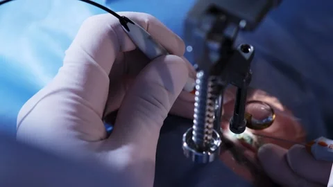 An ophthalmic surgery specialist performs an operation Stockbeeldmateriaal 265013341