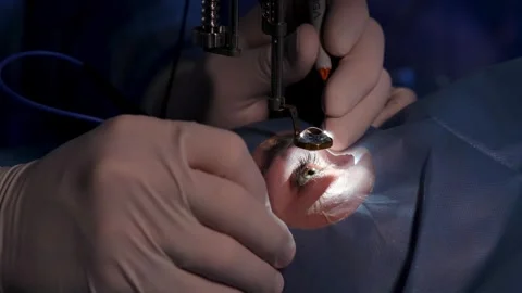 An ophthalmic surgery specialist performs an operation Stockbeeldmateriaal 265013472