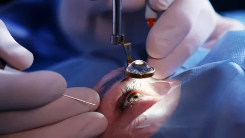 An ophthalmic surgery specialist performs an operation Stockbeeldmateriaal 265013474