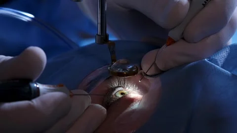 An ophthalmic surgery specialist performs an operation Stock Footage 265013516