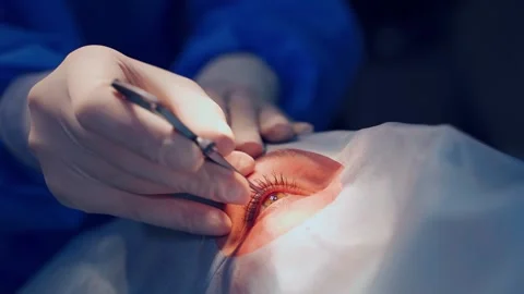 Ophthalmologist performs eye surgery with specialized instruments and syringe Stock Footage 337548524