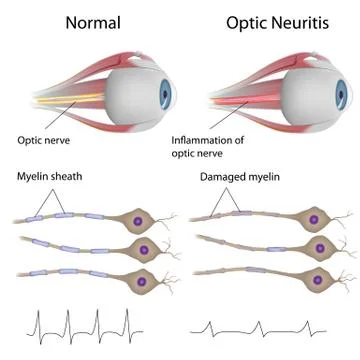 Optic neuritis Stock Illustration
