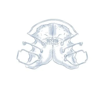 Orthodontic align teeth plate illustration blue Stock Illustration