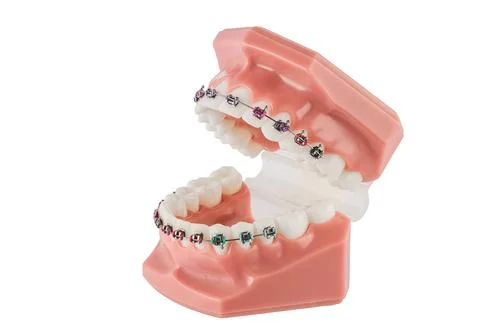 Orthodontic Braces On Upper And Lower Teeth In A Dental Model Stock Photos