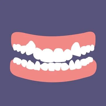 Orthodontic teeth problem crowding. Abnormal eruption. Double tooth Stock Illustration