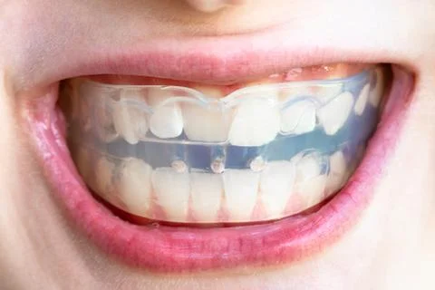Orthodontic trainer for correction of teeth bite Stock Photos