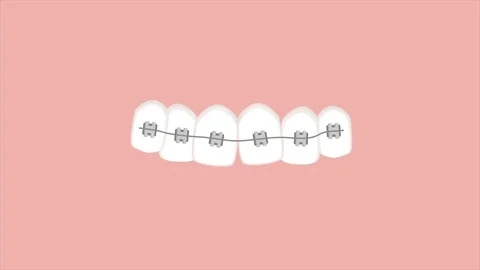 Orthodontic treatment 库存影片 82271127