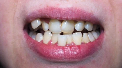 Orthodontics braces. Bad teeth needing medical attention Stock-Footage 108354841