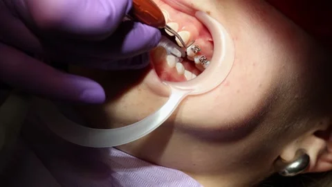 Orthodontist Applying Braces on Patient's Teeth Stock Footage 312629997
