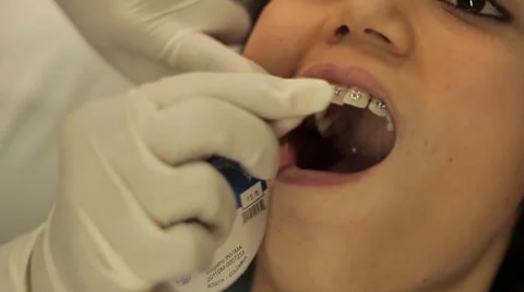At orthodontist applying a stretchable plastic chain Stock-Footage 33318555