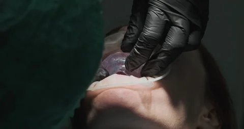 Orthodontist inserts transparent cap into patient's teeth. Close-up, teeth Stockbeeldmateriaal 243745748