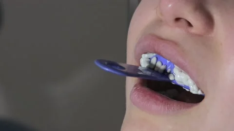 The orthodontist using dental impression tray on woman teeth. Stock Footage 147188738