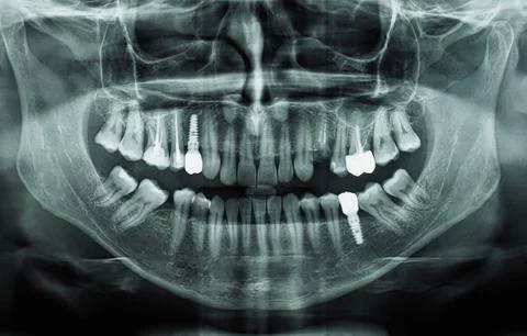 Orthopantomograph panoramic image radiograph of teeth Stock Photos