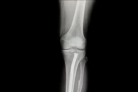 Orthopedic nail in the tibia Stock Photos