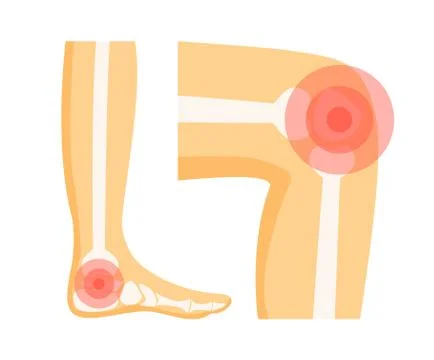 Orthopedic Problems in Foot Vector Illustration Stock Illustration