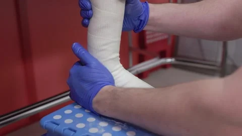 Orthopedic technician applying plaster cast on patient's ankle Stock Footage 343793168