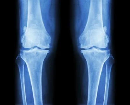 Osteoarthritis both knee .  film x-ray AP ( anterior - posterior ) of knee sh Stock Photos