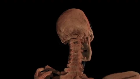 Osteoarthritis 動画素材 113762901