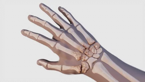 Osteoarthritis of the Hand Video stock 315156545