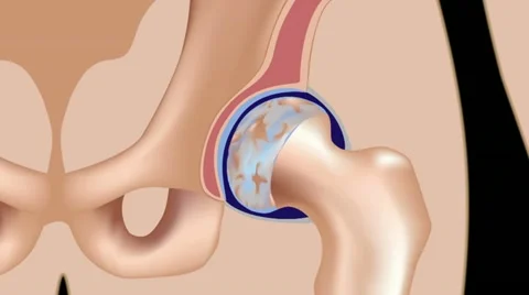 Osteoarthritis of hip joint Stock Footage
