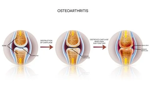 Osteoarthritis Stock Illustration