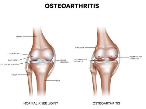 Osteoarthritis Stock Illustration