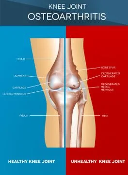 Osteoarthritis Stock Illustration