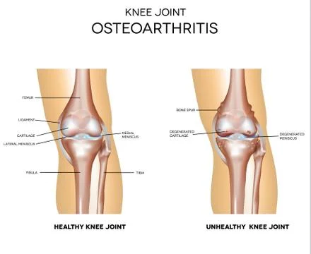 Osteoarthritis Stock Illustration