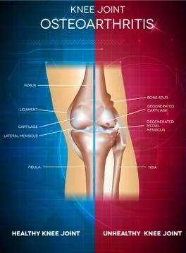 Osteoarthritis Illustrazione stock