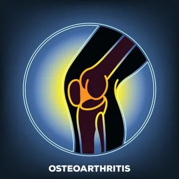 Osteoarthritis Stock Illustration