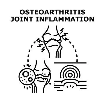 Osteoarthritis joint inflammation concept vector illustration Stock Illustration