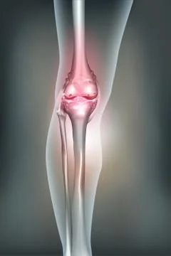 Osteoarthritis for the knee joint Stock Illustration