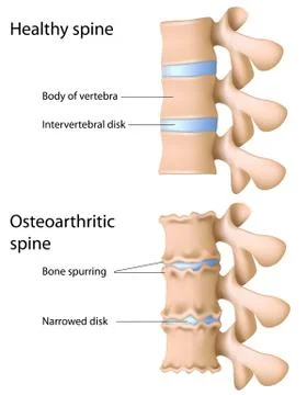 Osteoarthritis of the spine Stock Illustration
